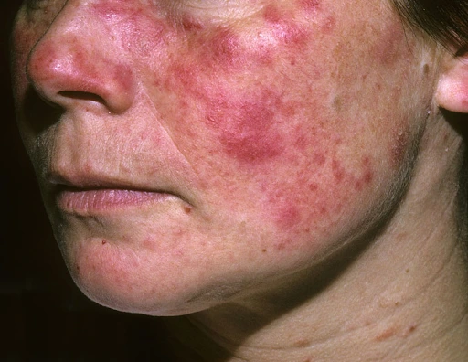 Hiểu về bệnh lupus ban đỏ hệ thống giúp điều trị hiệu quả